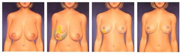 Breast Reduction Jacksonville FL